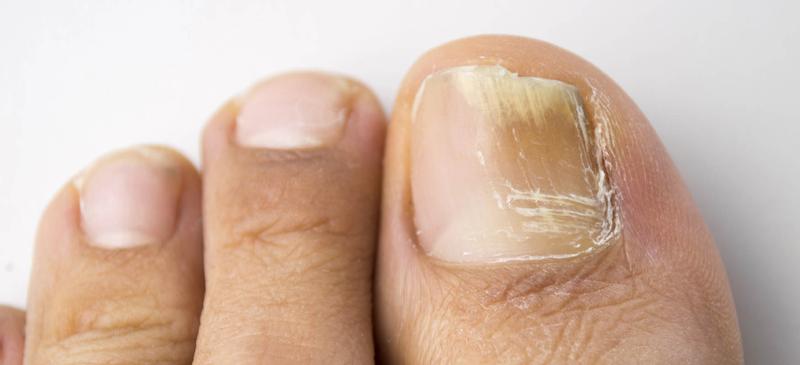 Grzybica paznokci leczenie