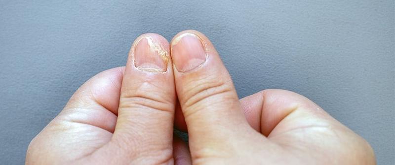 Naturalne metody grzybicy