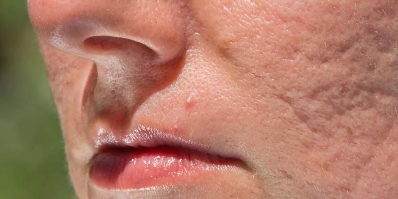 Naturalne składniki na pryszcze