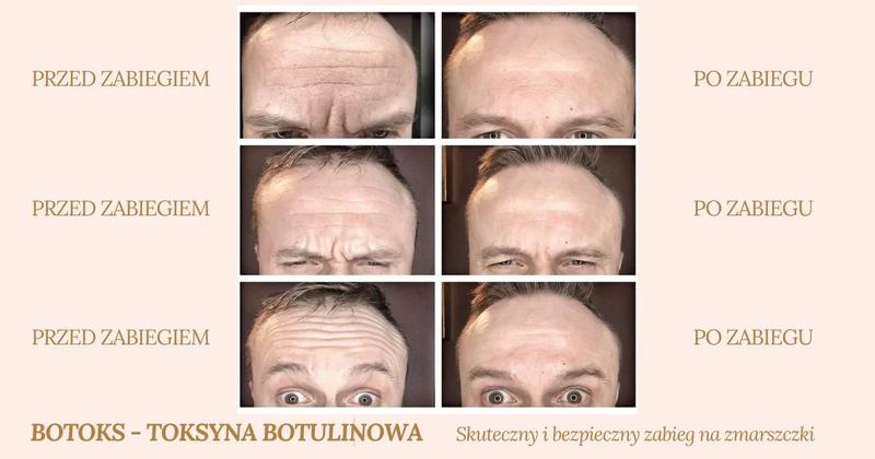 Alternatywy dla botoksu