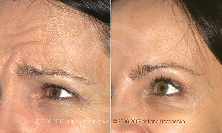 Bezpieczeństwo botoksu