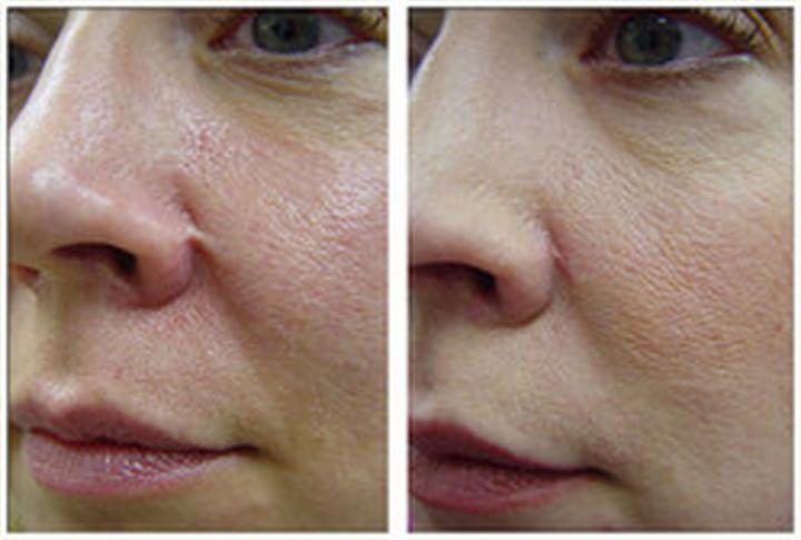 Działanie laserów na skórę