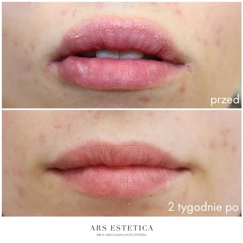 Hialuronidaza w dermatologii estetycznej