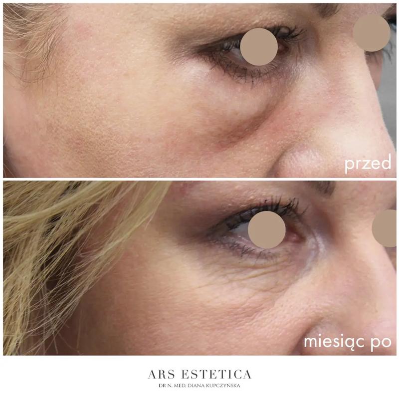 Mity o hialuronidazie