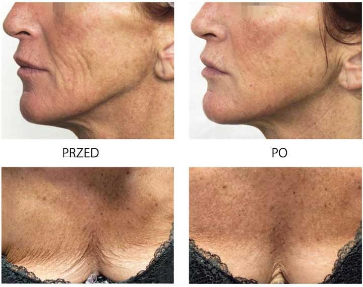 Peeling PRX T33