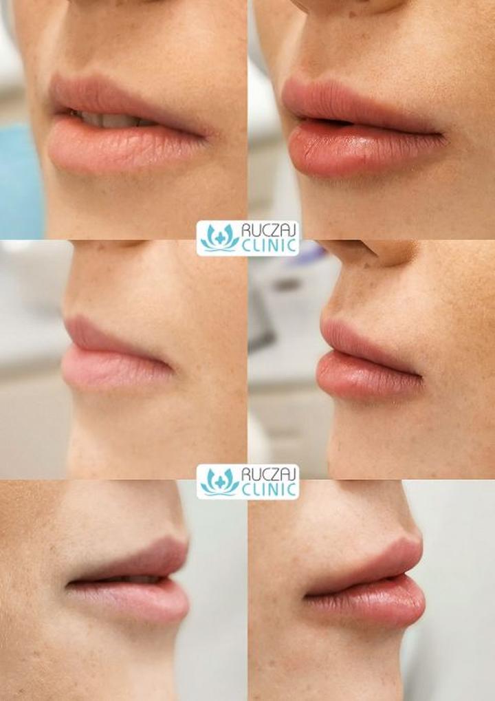 Powiększanie ust błędy