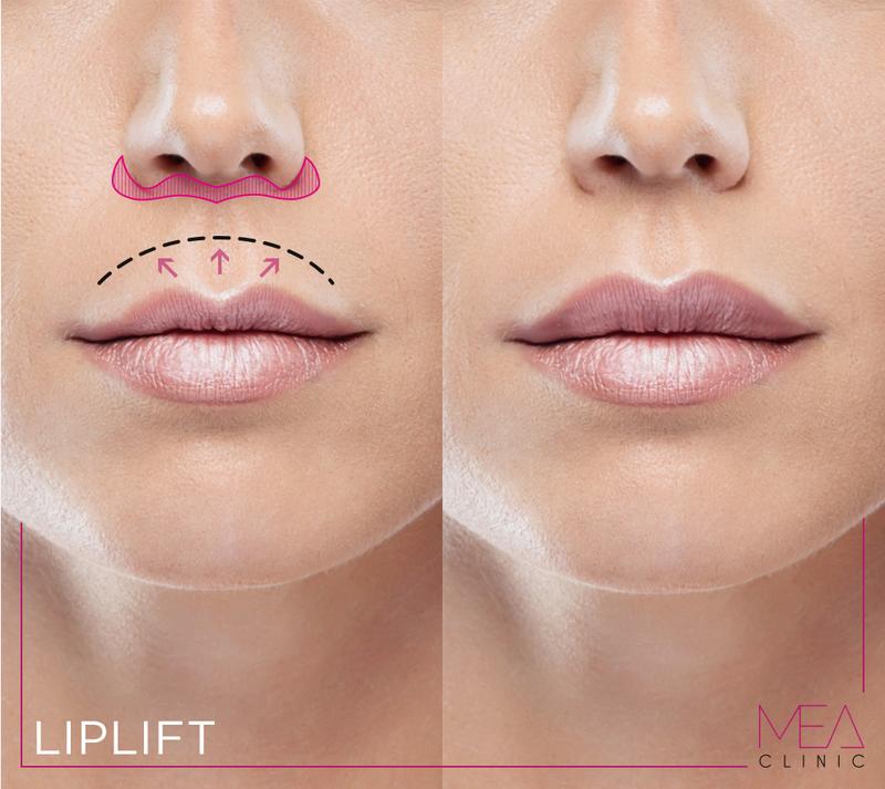 Preparaty do powiększania ust