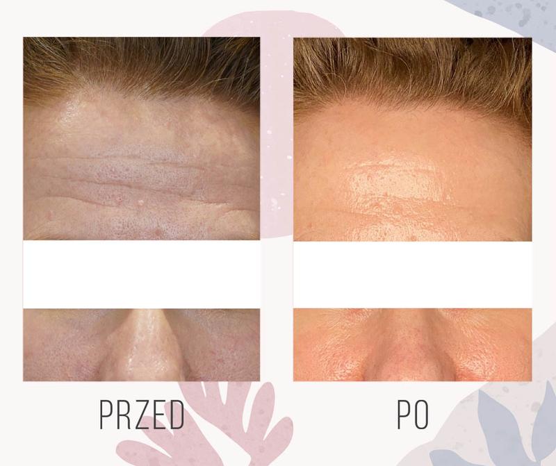 Przygotowanie do laseroterapii