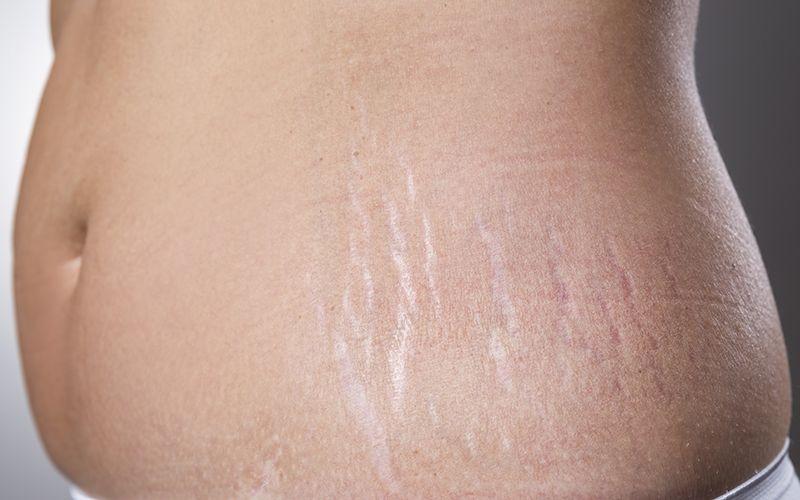 Redukcja rozstępów