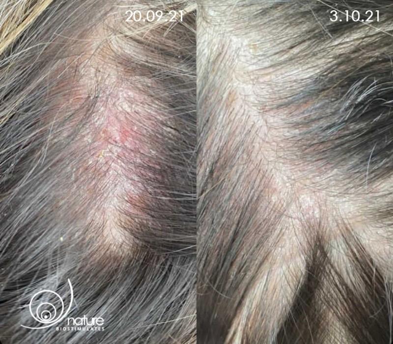 Techniki relaksacyjne na pieczenie skóry