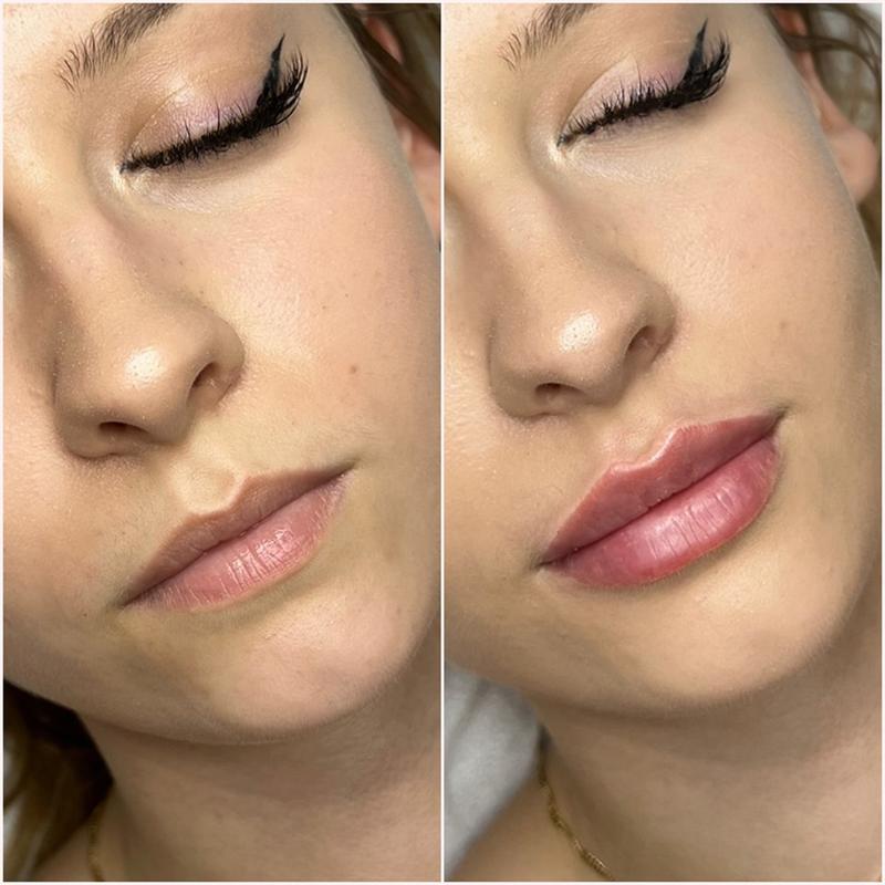 Zalecenia po powiększaniu ust