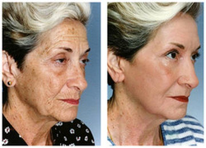 Zalety laseroterapii