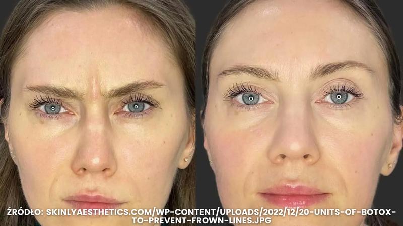 Jak botoks na czoło może odmienić Twój wygląd i samopoczucie?