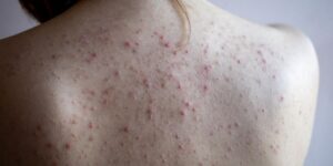 Jak skutecznie walczyć z trądzikiem na plecach? Sprawdzone metody i porady