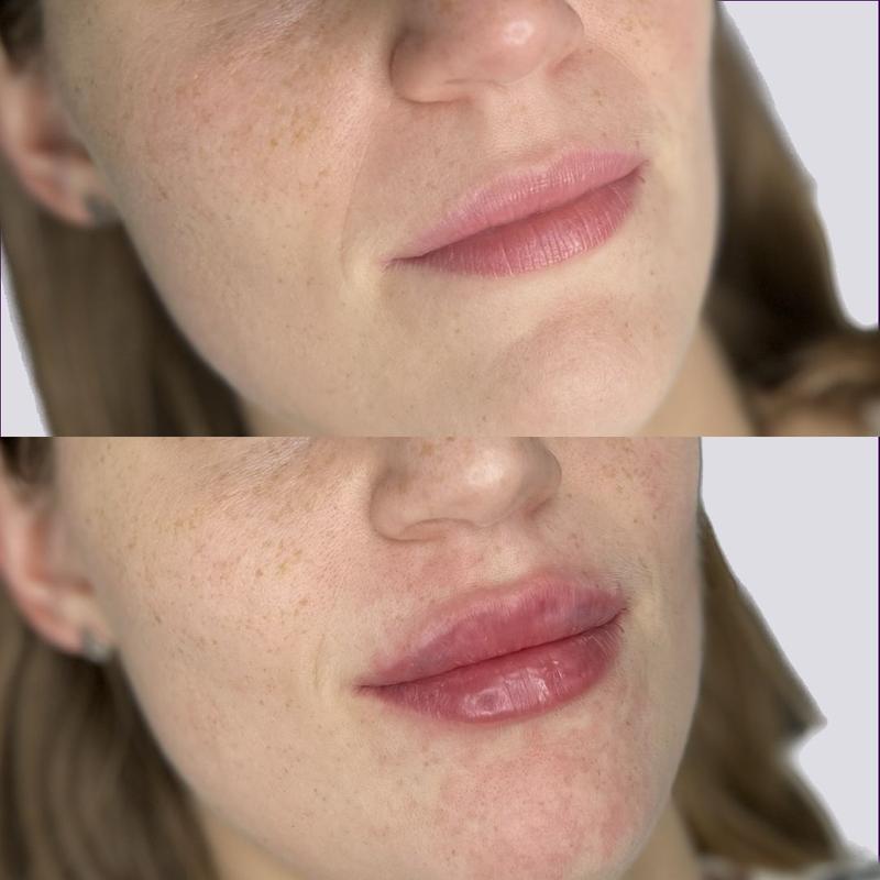 Bezpieczeństwo po zabiegu