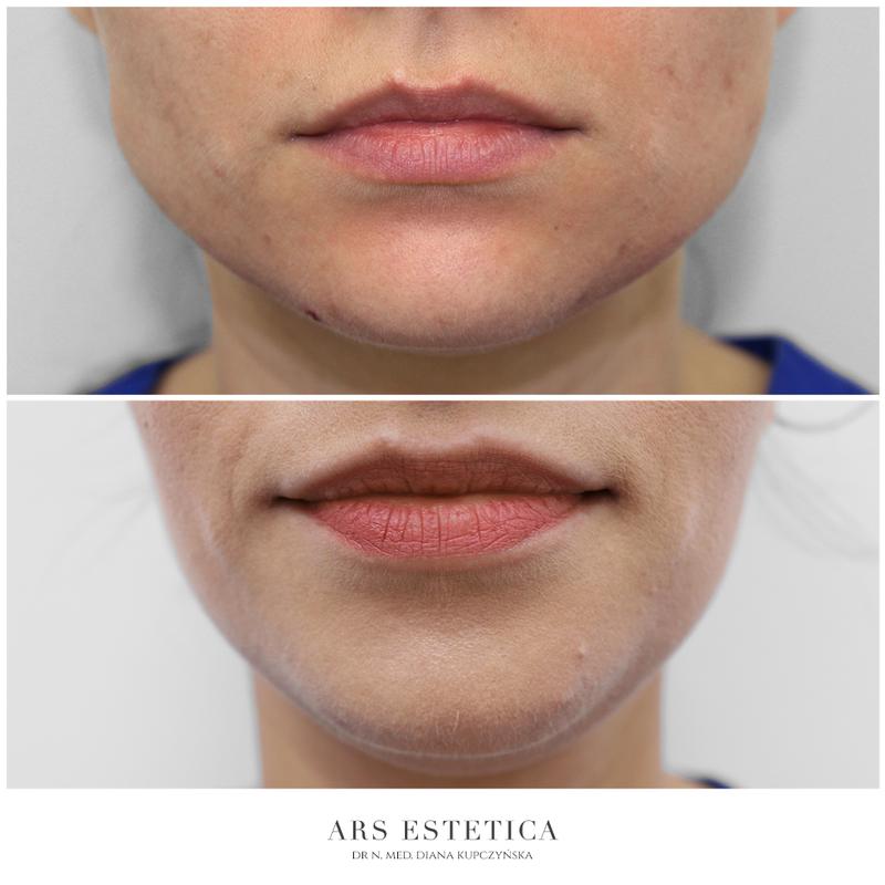 Bruksizm i zdrowie jamy ustnej