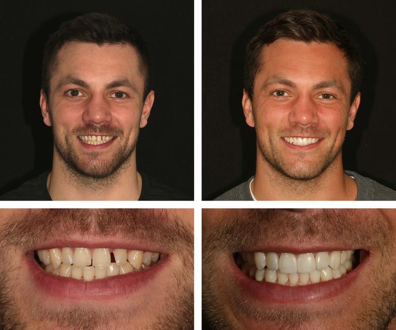 Koszty Invisalign
