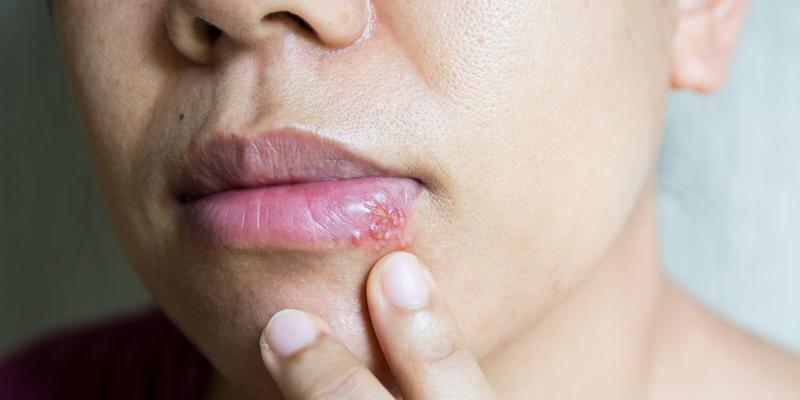 Łagodzenie objawów opryszczki