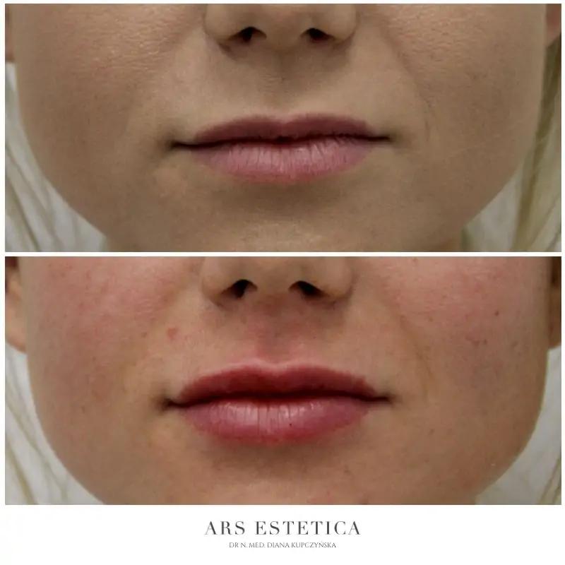 Laserowe powiększanie ust