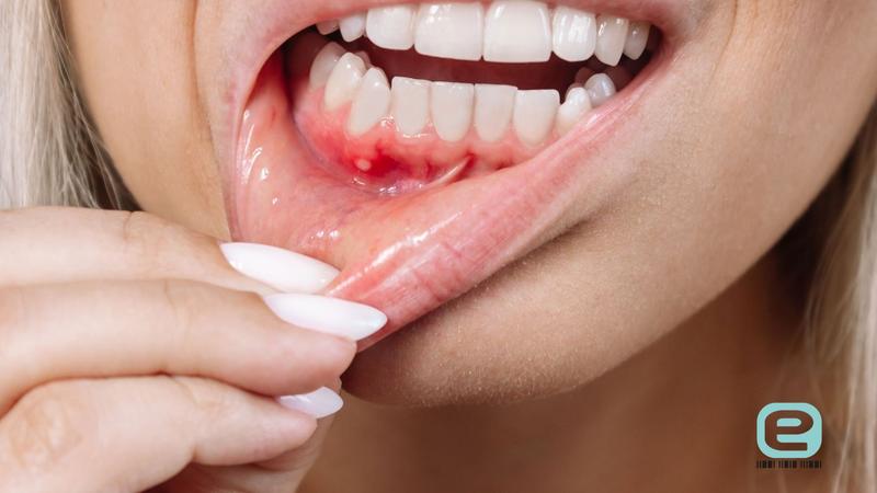 Naturalne metody na opryszczkę