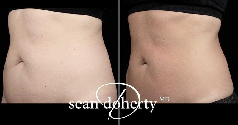 Redukcja tkanki tłuszczowej