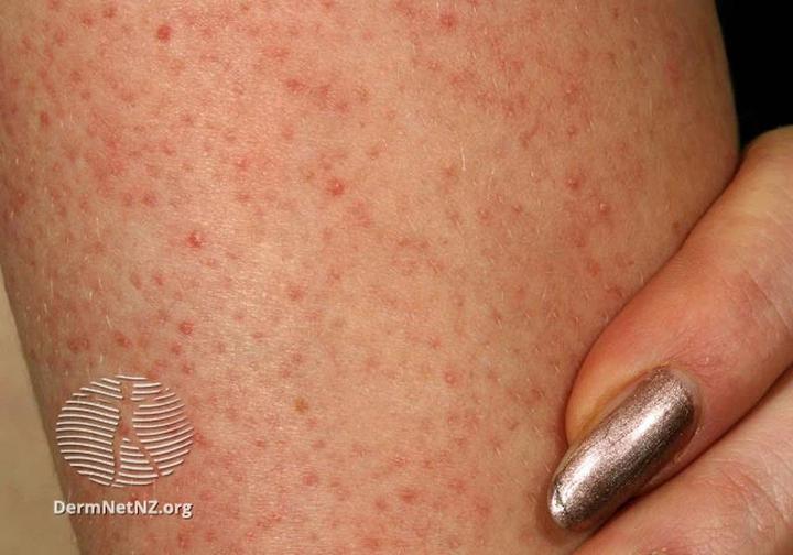 Skuteczne kosmetyki na pryszcze