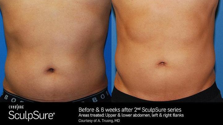 Technologia SculpSure