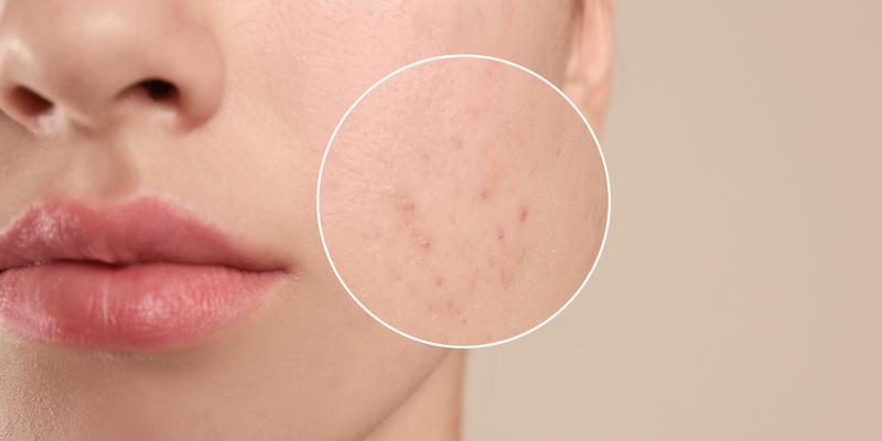 Wpływ diety na skórę