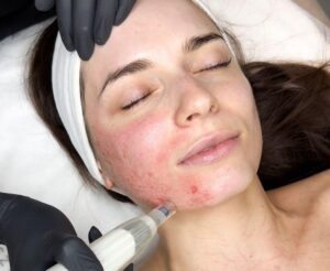 Odkryj magię mezoterapii mikroiglowej dla zdrowej i promiennej skóry