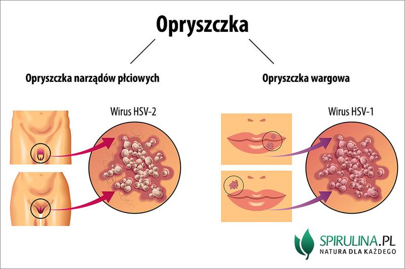 Skuteczne sposoby na walkę z opryszczką – porady i domowe metody