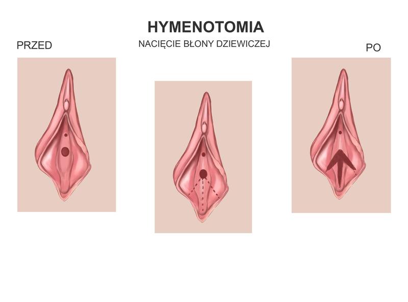 Zrozumienie hymenotomii: Kluczowe informacje i znaczenie dla zdrowia kobiet