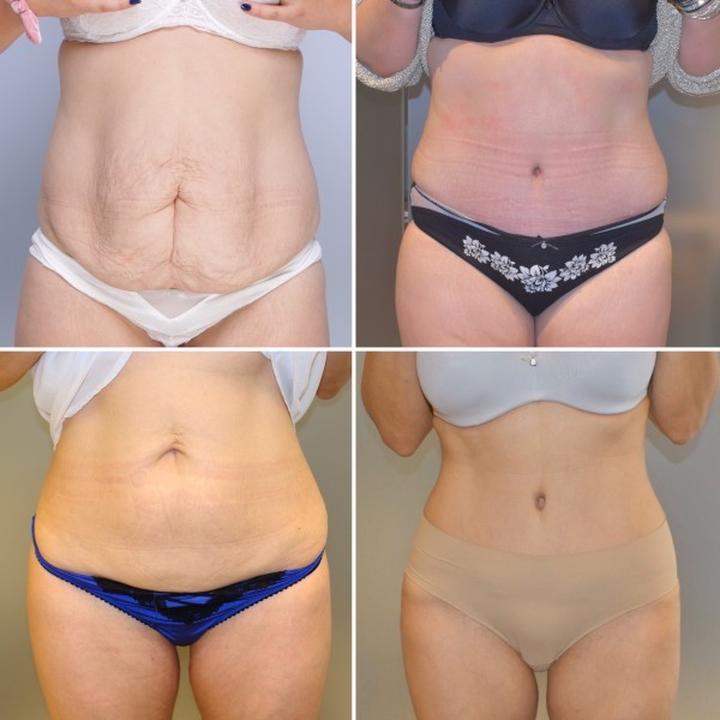 Abdominoplastyka a pewność siebie