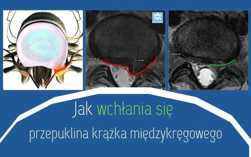 Diagnoza przepukliny kresy białej
