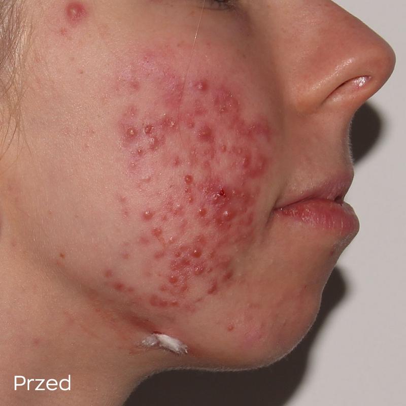 Leczenie trądziku