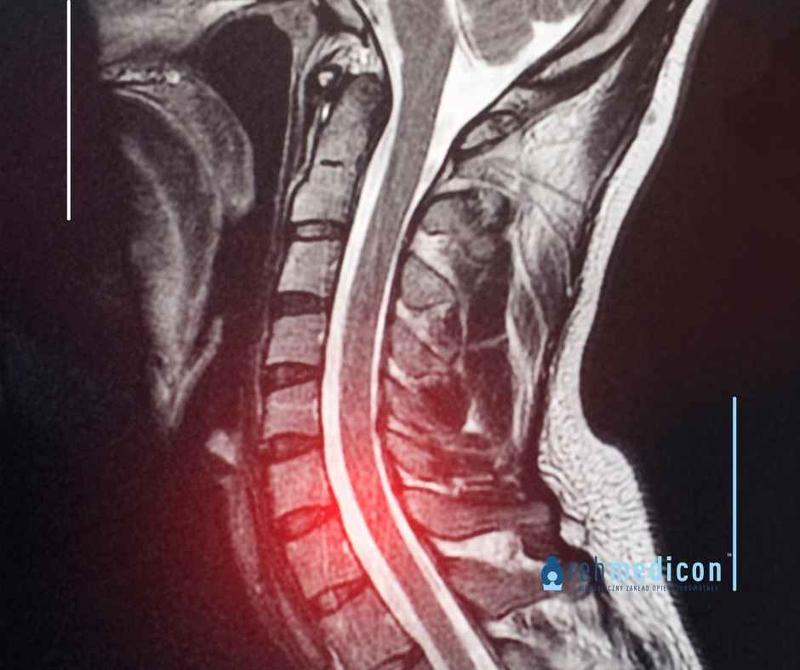 Przepuklina kresy białej