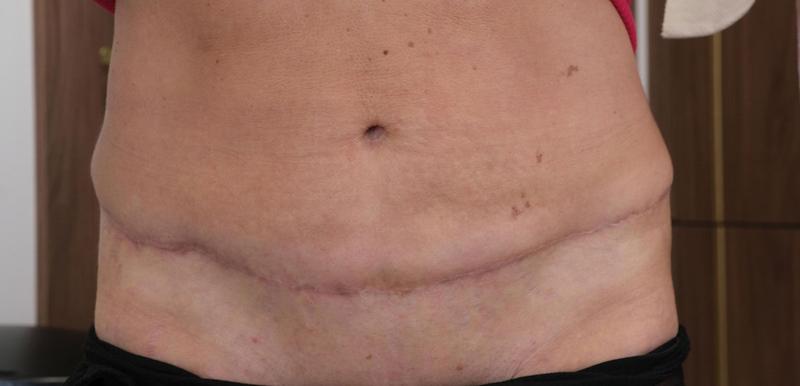 Przygotowanie do plastyki brzucha