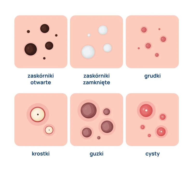 Psychologia trądziku