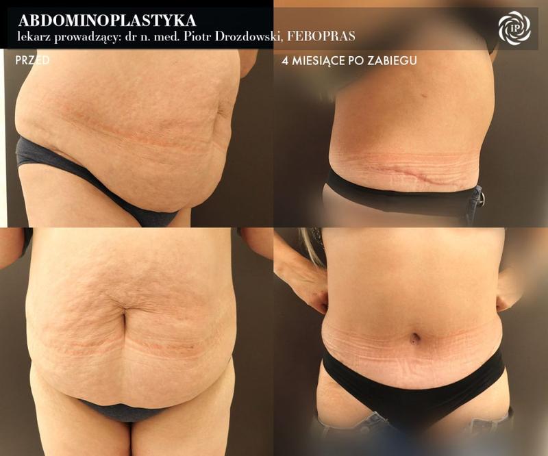 Dlaczego plastyka brzucha może zmienić twoje życie na lepsze?