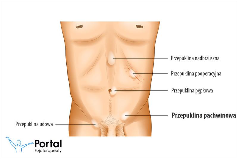 Jak rozpoznać i leczyć przepuklinę kresy białej?