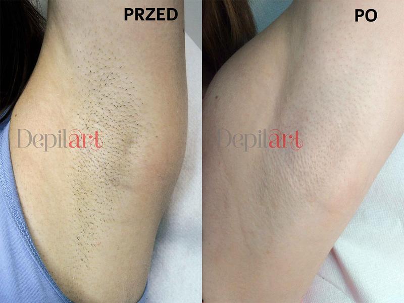 Skuteczne sposoby na to, jak ogolić pachy bez podrażnień