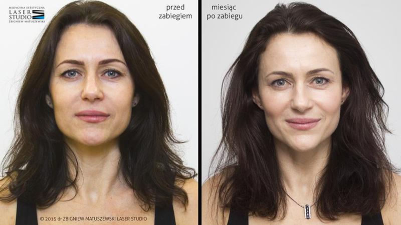 Skuteczne wyszczuplanie twarzy