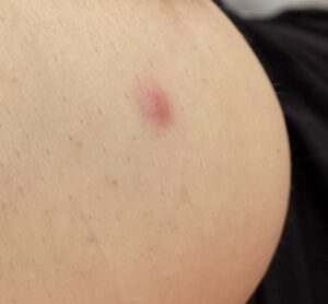 Jak radzić sobie z pryszczy na piersiach? Sprawdzone sposoby i porady