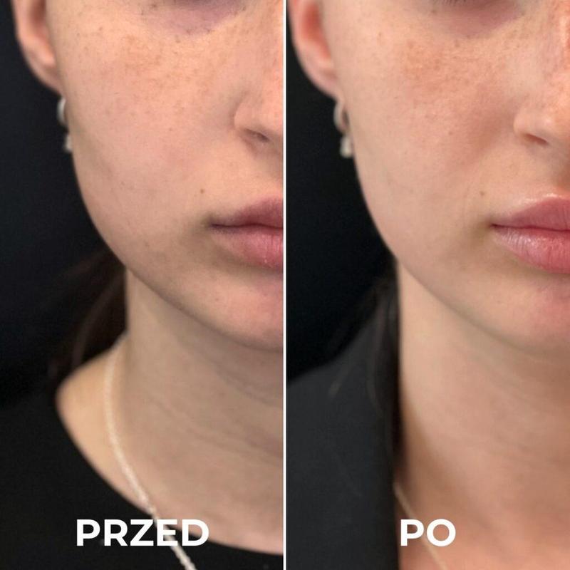 Sekrety skutecznego wyszczuplania twarzy - jak osiągnąć wymarzoną sylwetkę twarzy?