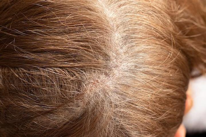 Skuteczne sposoby na walkę z krostami na głowie