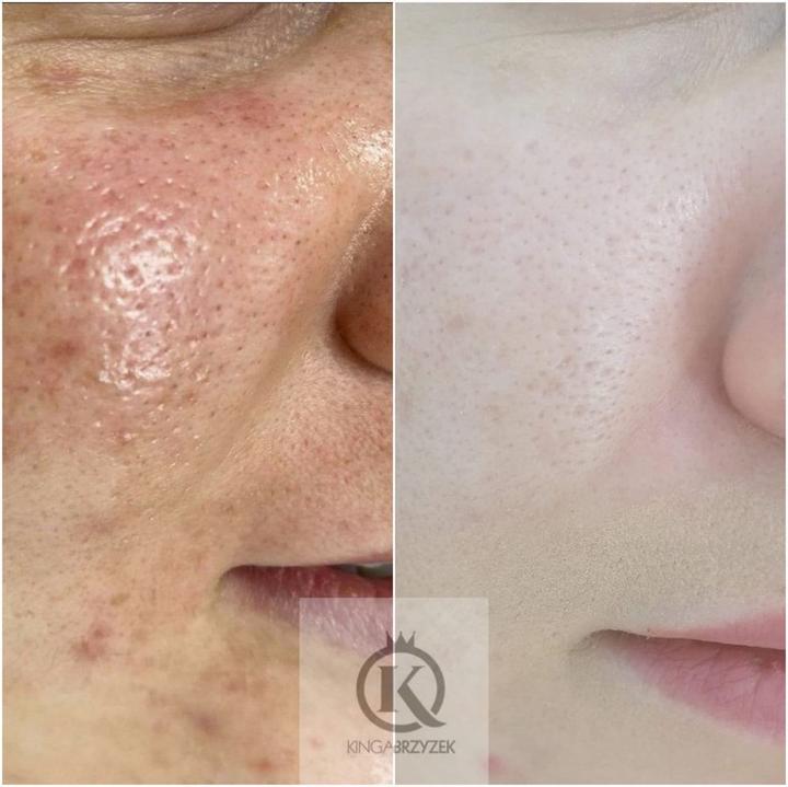Zamykanie porów i poprawa wyglądu skóry