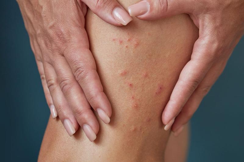 Jak skutecznie radzić sobie z pryszczami na nogach? Praktyczne porady i domowe sposoby