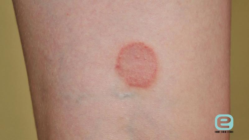 Liszaj płaski – co warto wiedzieć o tej nieprzyjemnej chorobie skórnej?