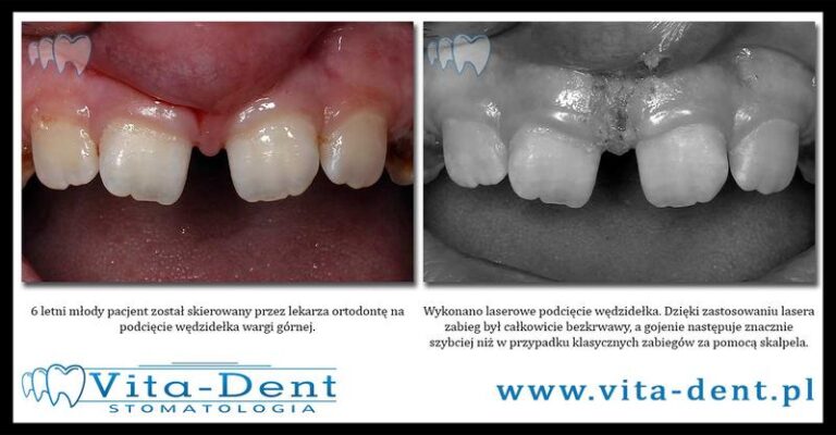 Nowoczesne metody laserowego podcięcia wędzidełka – co warto wiedzieć?