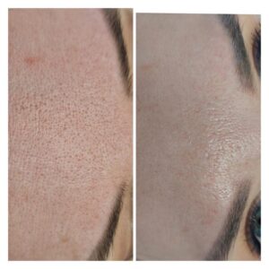 Skuteczne metody na zamykanie porów i poprawę wyglądu skóry