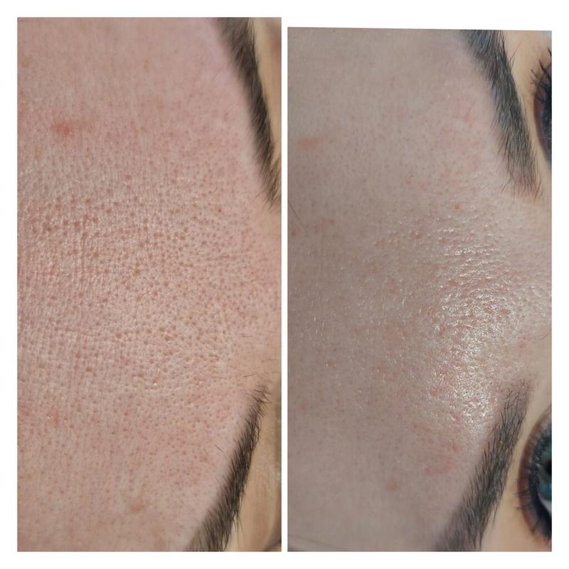 Skuteczne metody na zamykanie porów i poprawę wyglądu skóry